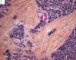 Desmoplastic small round cell tumor (DSRCT)