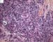 Desmoplastic small round cell tumor (DSRCT)