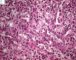 Splenic spumous macrophagic infiltration (Mycobacterium avium infection in (...)