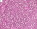 Embryonal component of an epithelial hepatoblastoma