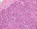 Embryonal component of an epithelial hepatoblastoma