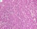 Embryonal component of an epithelial hepatoblastoma