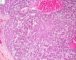Embryonal component of an epithelial hepatoblastoma