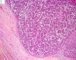 Embryonal component of an epithelial hepatoblastoma