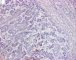 Embryonal component of an epithelial hepatoblastoma