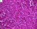 Embryonal component of an epithelial hepatoblastoma