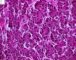Embryonal component of an epithelial hepatoblastoma