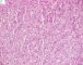 Fetal component of an epithelial hepatoblastoma