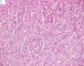 Fetal component of an epithelial hepatoblastoma