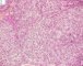 Fetal component of an epithelial hepatoblastoma