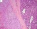 Embryonal component of an epithelial hepatoblastoma (+ limit)