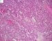 Embryonal component of an epithelial hepatoblastoma