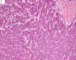 Embryonal component of an epithelial hepatoblastoma