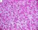 Fetal component of an epithelial hepatoblastoma