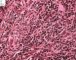 Poorly differentiated neuroblastoma (case 13512)
