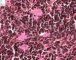 Poorly differentiated neuroblastoma (case 13512)