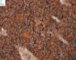 Poorly differentiated neuroblastoma (case 13512)