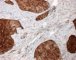 Desmin in desmoplastic small round cell tumor (DSRCT)
