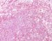 Testicular endodermal sinus tumor (Yolk sac tumor)