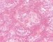 Testicular endodermal sinus tumor (Yolk sac tumor)