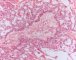 Testicular endodermal sinus tumor (Yolk sac tumor)