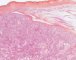 Testicular endodermal sinus tumor (Yolk sac tumor)