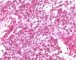 Testicular endodermal sinus tumor (Yolk sac tumor)