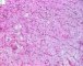 Myxoid liposarcoma