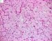 Myxoid liposarcoma