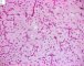 Myxoid liposarcoma