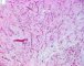 Myxoid liposarcoma