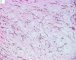 Myxoid liposarcoma