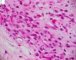 Myxoid liposarcoma