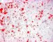Myxoid liposarcoma (Oil-Red-O)
