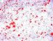 Myxoid liposarcoma