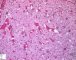 Focal adrenal cytomegaly in 47,XXX fetus ith ring chromosome (...)