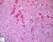 Focal adrenal cytomegaly in 47,XXX fetus ith ring chromosome (...)