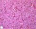 Focal adrenal cytomegaly in 47,XXX fetus ith ring chromosome (...)