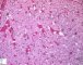 Focal adrenal cytomegaly in 47,XXX fetus ith ring chromosome (...)