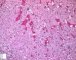 Focal adrenal cytomegaly in 47,XXX fetus ith ring chromosome (...)