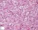 Large round tumoral cells in malignant rhabdoid tumor