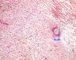 cutaneous north american brugiasis