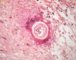 cutaneous north american brugiasis