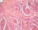 Plexiform schwannoma