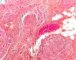 Plexiform schwannoma