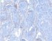 Plexiform schwannoma (EMA)