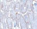 Plexiform schwannoma (GLUT1)