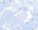 Plexiform schwannoma (NF)