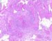Plexiform schwannoma (PAS-Alcian blue)