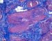 Plexiform schwannoma (Masson trichrome)